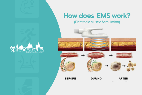 EMS treatment for post pregnancy weight loss treatment Calton