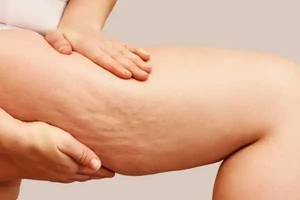 Image of woman showing leg with cellulite Calton