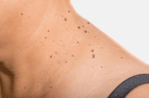 Are you looking for easy skin tag removal Calton - then contact Spire today!