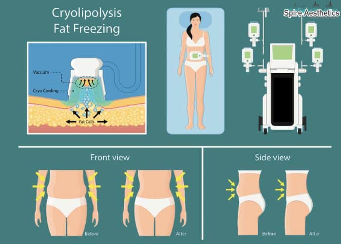 Image of diet and fat freezing combined for best results for Spire Aesthetics Calton