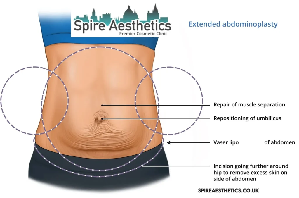 Understanding Loose Skin After Gastric Band Calton Surgery and HIFU Treatment