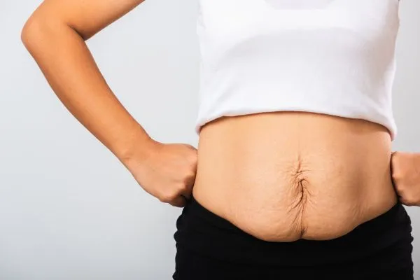 Image of a woman's stomach after weight loss with sagging skin following a gastric band Calton