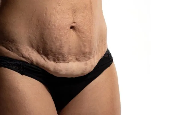 Image of womans stomach after weight loss injections Calton showing saggy skin